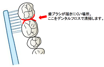 歯と歯の間のハブラシが届きにくい場所