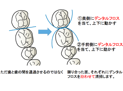 デンタルフロスを歯に巻きつけるように歯に沿わせて使用すると、より効果的に歯垢を除去することができます。
