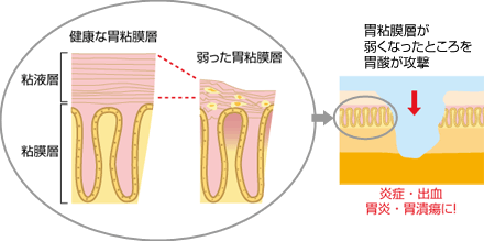 「胃炎」が起こる仕組み