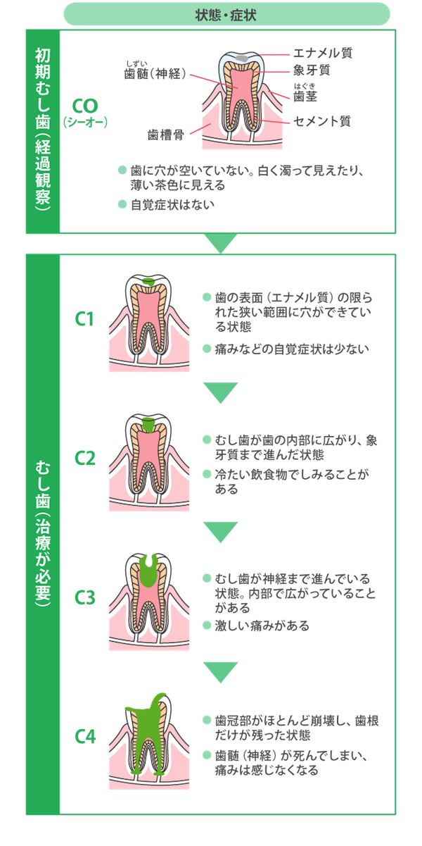 むし歯の進行と対処法