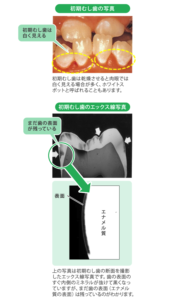 初期虫歯の特徴