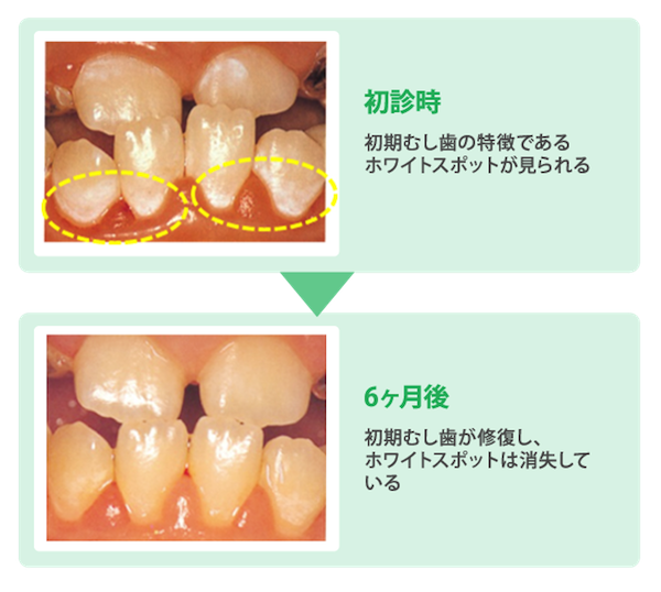 初期むし歯と診断されてから適切なケアを行った6ヶ月後の歯の状態