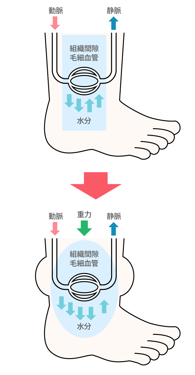 「水分バランス」が崩れるとむくみが生じる