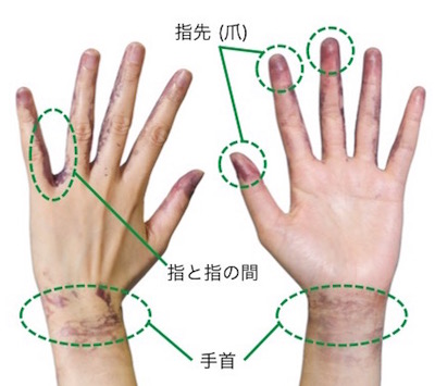 手洗いのあとに残った汚れを着色した様子