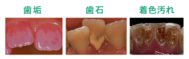 着色汚れ