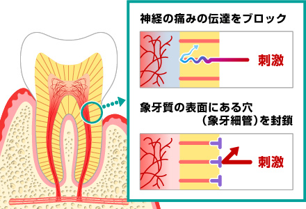 知覚過敏ケア