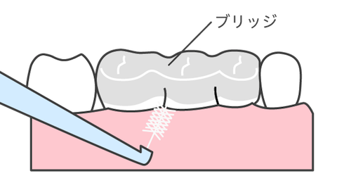 「歯間ブラシ」でいつもキレイに