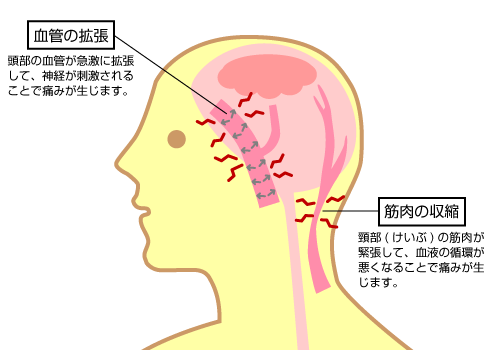 頭痛が起きる「メカニズム」