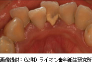 歯石による様々な「リスク」