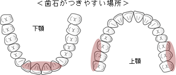 歯石がつきやすい場所