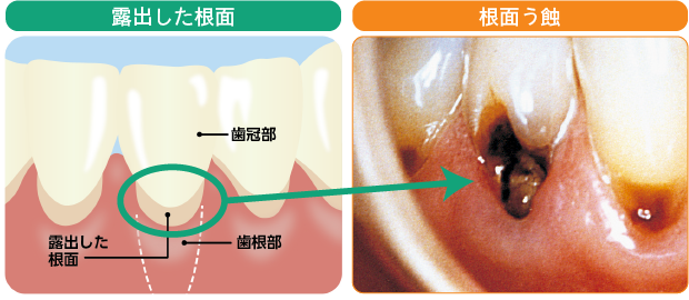 露出した根面 根面う蝕