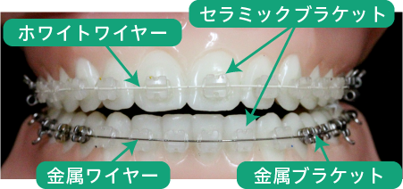 各種素材の矯正装置を取り付けた模型