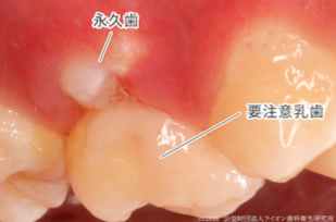 要注意乳歯の例